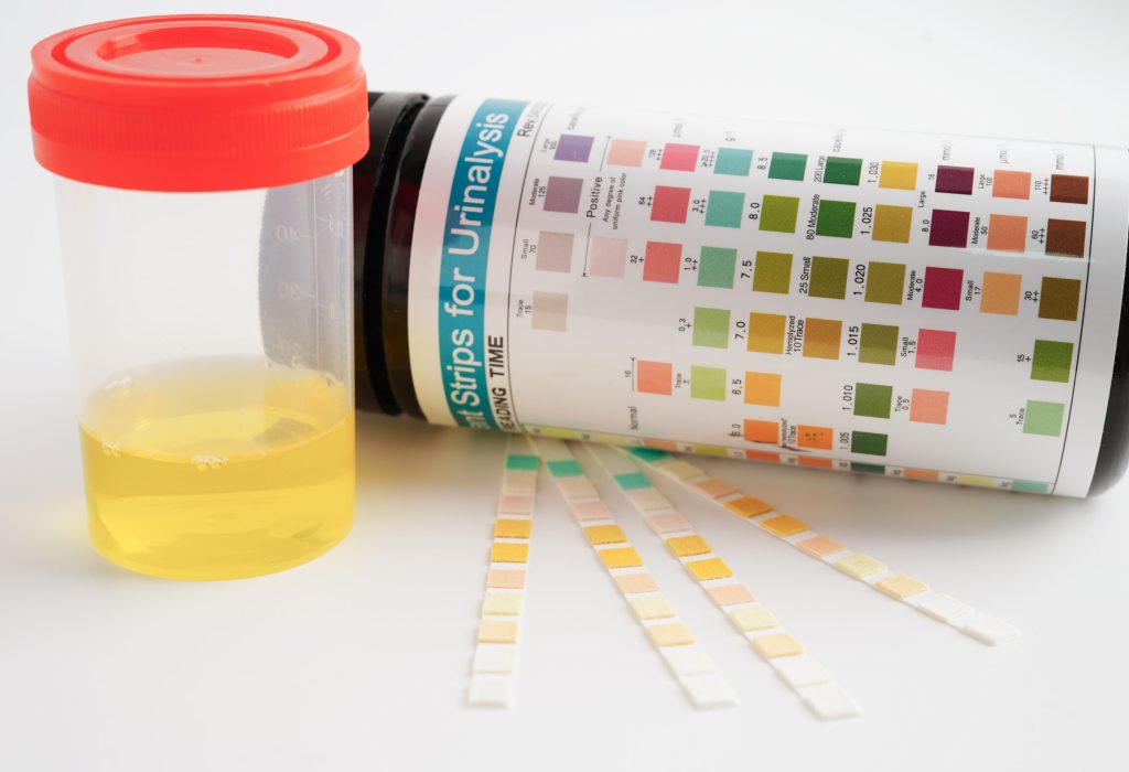 Urinalysis, urine cup with reagent strip pH paper test and comparison chart in laboratory.